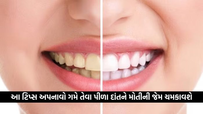 પીળા દાંતને કારણે તમે શરમ અનુભવો છો; તો અપનાવો આ ટિપ્સ, માત્ર 15 જ દિવસમાં દાંતને મોતીની જેમ ચમકાવશે….